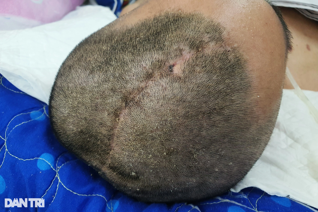 Nam sinh viên ở TPHCM phải tháo sọ não, nằm như người thực vật sau buổi học - 2 Nam sinh viên ở TPHCM phải tháo sọ não, nằm như người thực vật sau buổi học - 2