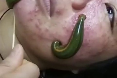 Kinh hãi kiểu làm đẹp bằng cách... bỏ con đỉa lên mặt để hút sạch mụn