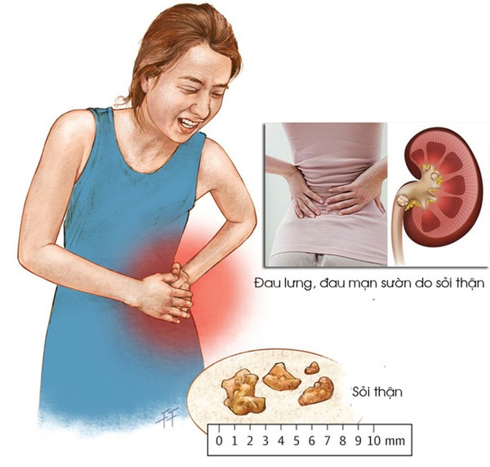 Sỏi thận, sỏi tiết niệu mãi không hết chỉ vì 4 điều ai cũng tưởng là đúng - 1 Sỏi thận, sỏi tiết niệu mãi không hết chỉ vì 4 điều ai cũng tưởng là đúng - 1