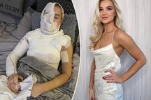 Ngôi sao mạng xã hội bị bỏng nghiêm trọng vì làm clip hướng dẫn mẹo vặt