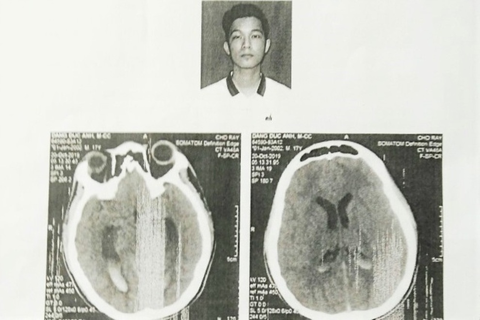 Khởi tố thêm 2 bị can vụ nam sinh bị đánh chấn thương não - 1 Khởi tố thêm 2 bị can vụ nam sinh bị đánh chấn thương não - 1
