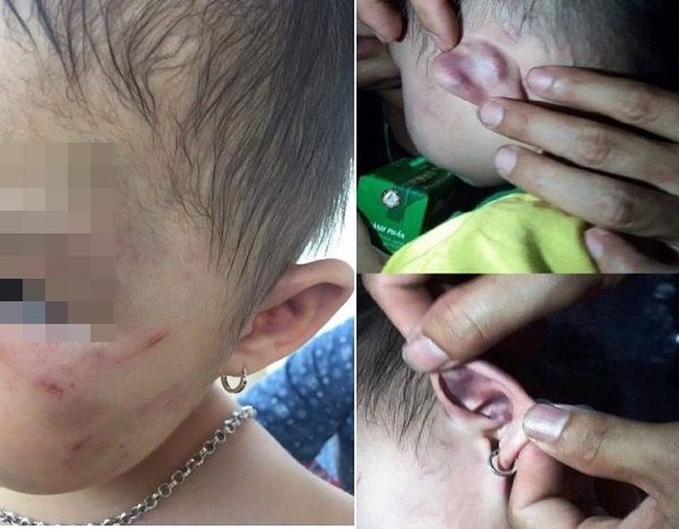 Phụ huynh tố cô giáo đánh bé gái 30 tháng tuổi bị thương - 1 Phụ huynh tố cô giáo đánh bé gái 30 tháng tuổi bị thương - 1