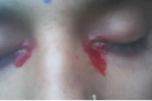 Mắc bệnh hiếm, cô gái khóc ra máu trong kỳ kinh nguyệt