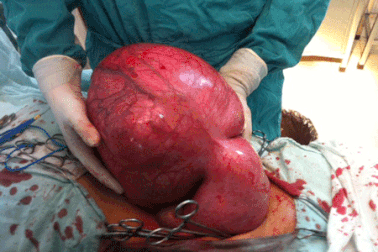 Phát hiện khối u “khủng” 10kg trong bụng bệnh nhân