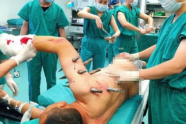 Công nhân Trung Quốc bị robot xiên 10 đinh thép khắp cơ thể