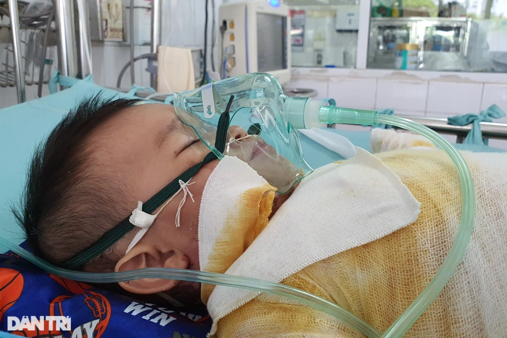 Bỏng nước sôi 66% cơ thể, bé 20 tháng tuổi nguy kịch xin cứu tính mạng - 7 Bỏng nước sôi 66% cơ thể, bé 20 tháng tuổi nguy kịch xin cứu tính mạng - 7