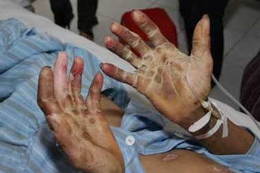 Chết vì “ăn sống nuốt tươi”