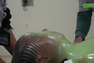 Chiếc mặt nạ xạ trị trong trận chiến với ung thư của cô bé 11 tuổi