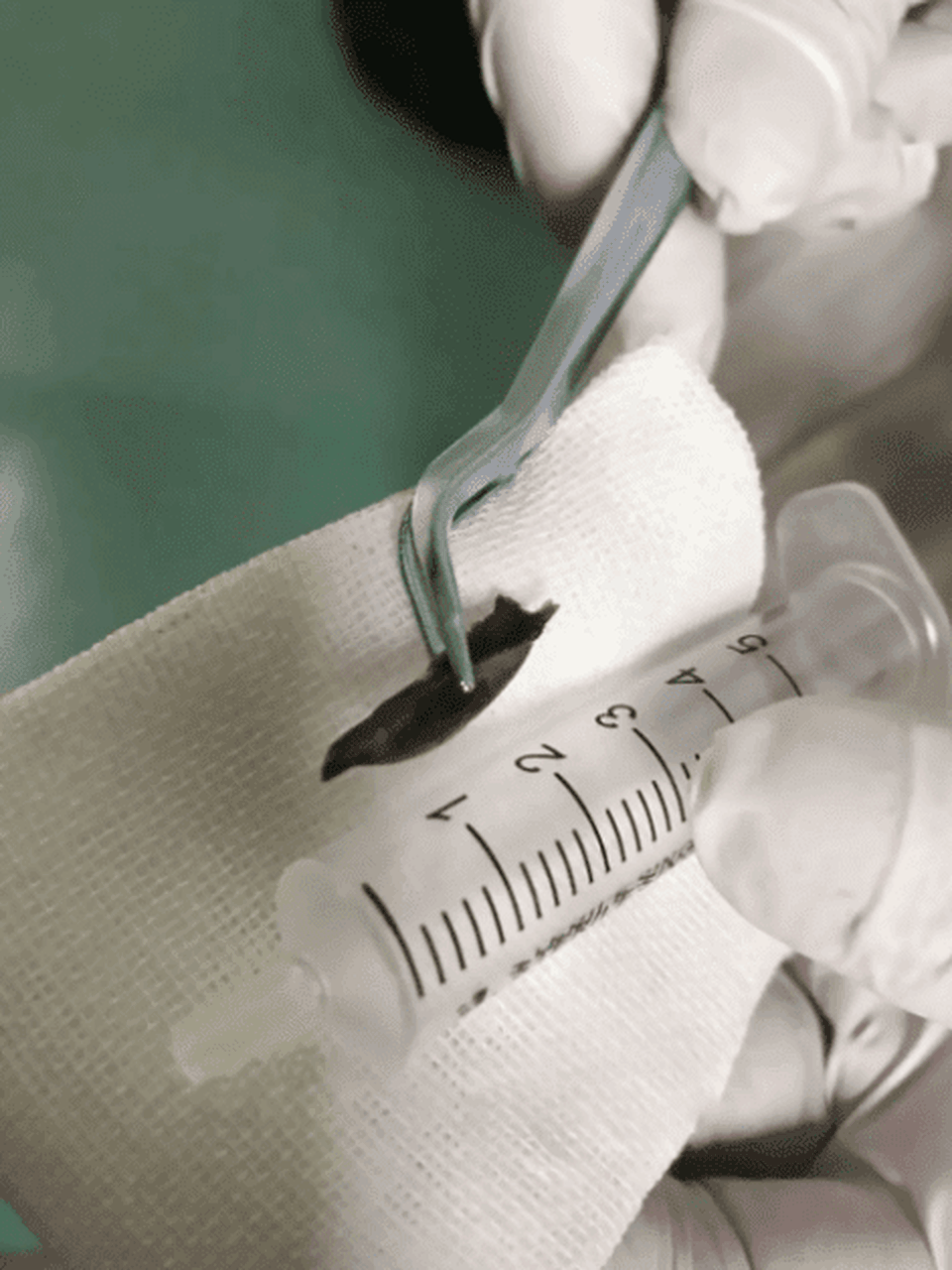 Ho dai dẳng 14 năm vì xương gà nằm trong phổi - 2 Ho dai dẳng 14 năm vì xương gà nằm trong phổi - 2