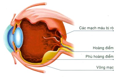 Phù hoàng điểm do đái tháo đường là nguyên nhân gây mù hàng đầu ở người trong độ tuổi lao động