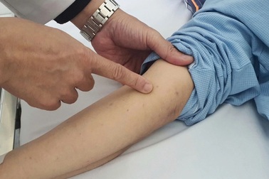 Tăng ca viêm màng não do não mô cầu, 82 người mắc trong 9 tháng