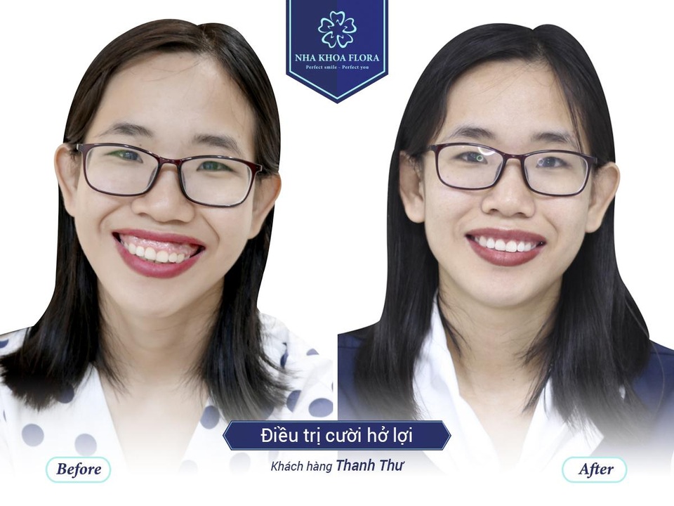 3 cách cười không hở lợi mới nhất bạn nên biết - 3 3 cách cười không hở lợi mới nhất bạn nên biết - 3