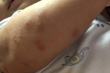 Khốn khổ trẻ nứt da, ngứa ngáy vì viêm da cơ địa mùa lạnh