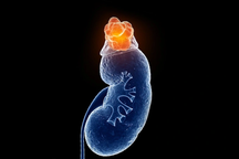 Phát hiện khối u từ cơn đau bụng bất thường