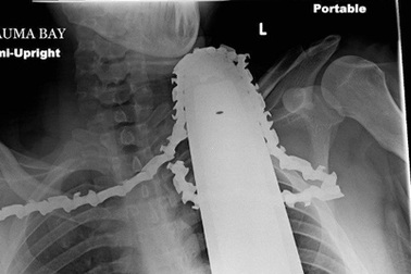 Thoát chết sau khi lưỡi cưa máy cắm sâu vào cổ