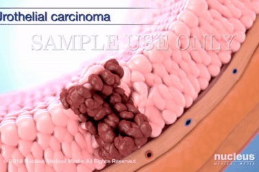 Mục sở thị quá trình hình thành của bệnh ung thư đường tiết niệu phổ biến nhất