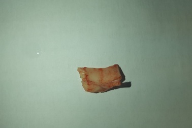 Nhập viện cứu cấp vì bị hóc xương khi ăn bún giò