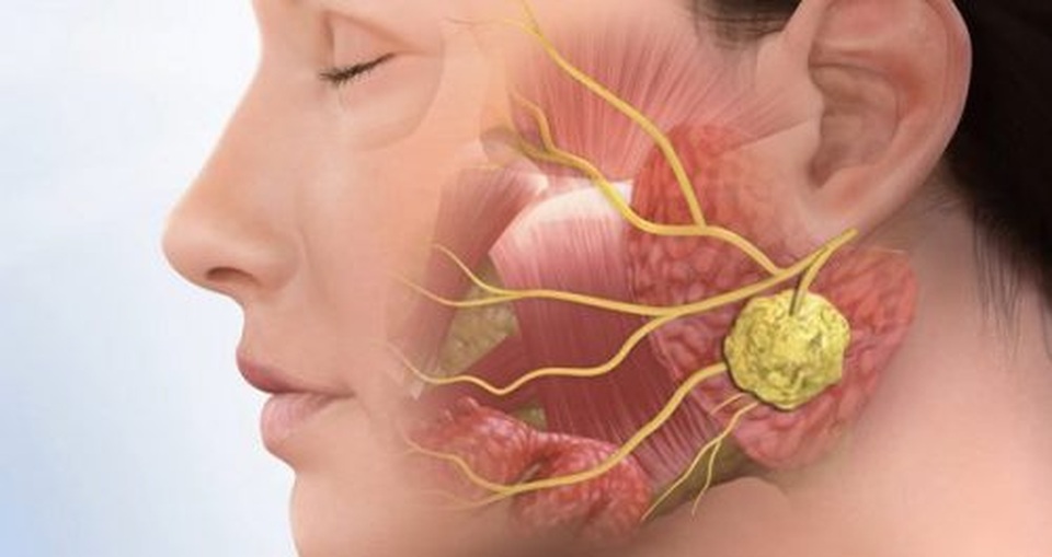 Phân biệt ung thư vòm họng với bệnh lý vùng mũi họng - 1 Phân biệt ung thư vòm họng với bệnh lý vùng mũi họng - 1