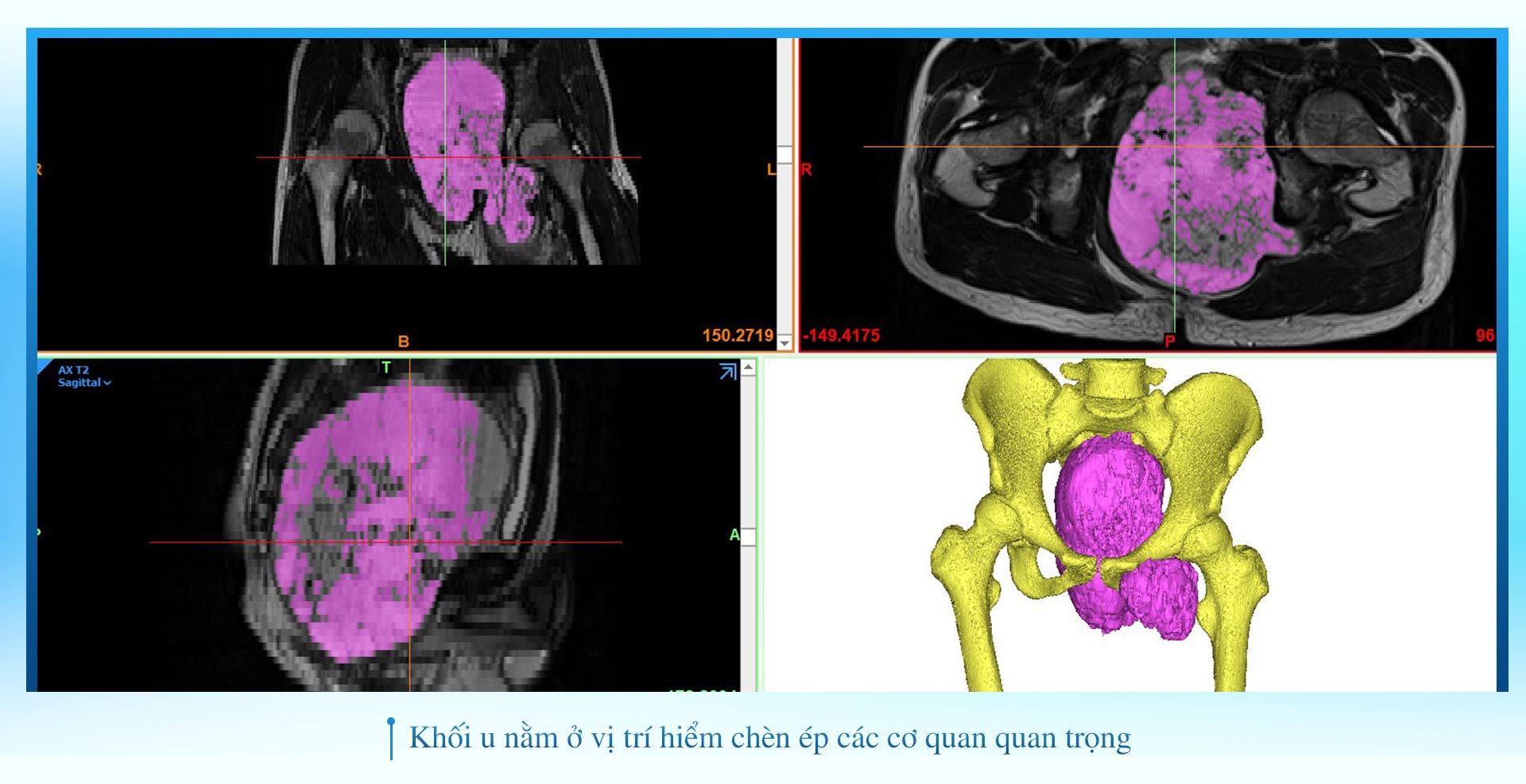 Chiến dịch ngoạn mục giải cứu chàng trai 19 tuổi khỏi khối u xương khổng lồ - 15 Chiến dịch ngoạn mục giải cứu chàng trai 19 tuổi khỏi khối u xương khổng lồ - 15
