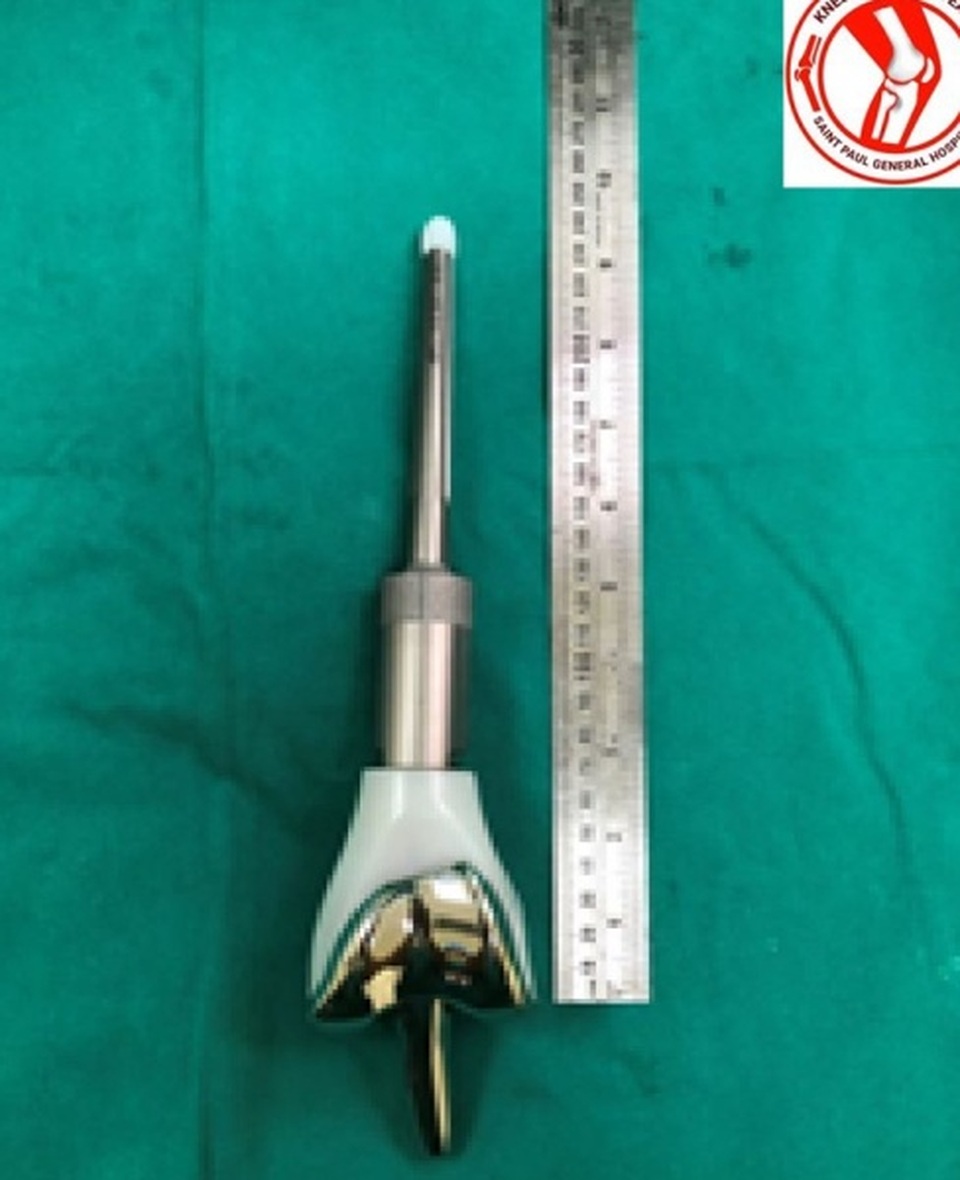 Đau âm ỉ 5 tháng, nữ sinh 16 tuổi bất ngờ phát hiện bị ung thư xương - 2 Đau âm ỉ 5 tháng, nữ sinh 16 tuổi bất ngờ phát hiện bị ung thư xương - 2