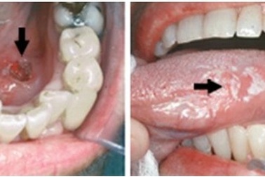 8 dấu hiệu cảnh báo sớm ung thư khoang miệng