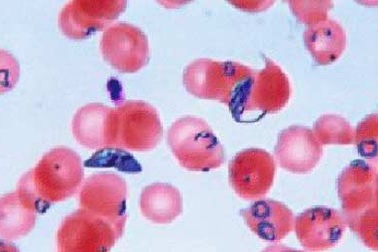 Phát hiện chủng ký sinh trùng sốt rét kháng thuốc