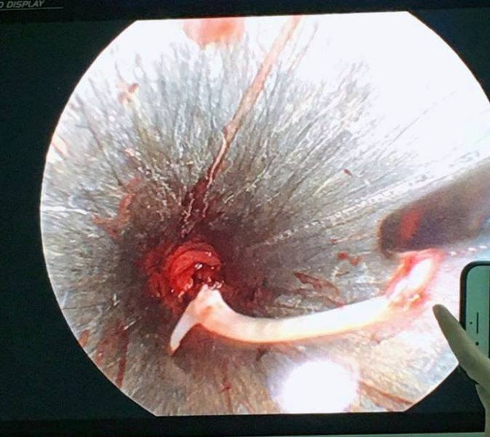 Người đàn ông suýt mất mạng vì tin lời thầy mo uống “nước thần” để chữa hóc xương cá - 1 Người đàn ông suýt mất mạng vì tin lời thầy mo uống “nước thần” để chữa hóc xương cá - 1