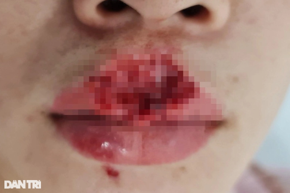 Kẹt chân vào bánh xe, chó cắn nát mặt và những hiểm họa tấn công trẻ mùa hè - 5 Kẹt chân vào bánh xe, chó cắn nát mặt và những hiểm họa tấn công trẻ mùa hè - 5