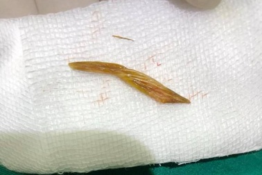 Hy hữu: Đau rát hậu môn, tưởng bệnh trĩ hóa ra do nuốt phải xương cá