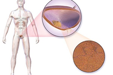 Ăn uống trong phòng - chữa ung thư bàng quang