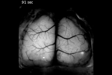 Cấy ghép xương sọ trong suốt cho phép quan sát trực tiếp bộ não đang sống