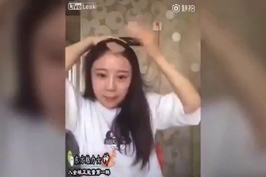 Ăn ngô bằng máy khoan, cô gái mất nguyên mảng da đầu