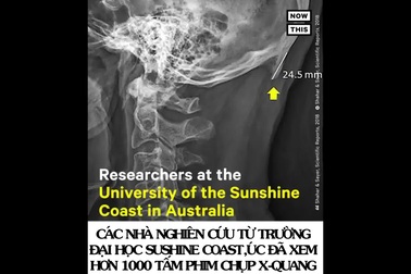 Nghiện Smartphone có thể khiến chúng ta “mọc sừng” theo nghĩa đen!