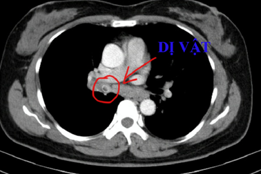 Ho, sốt kéo dài vì hạt hồng xiêm nằm trong phế quản 4 năm