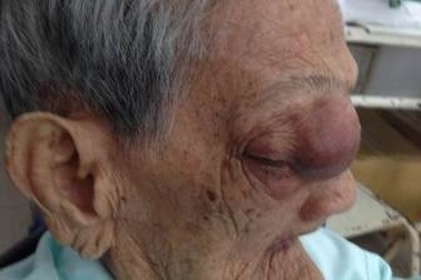 Mổ khối u nhầy, cứu mẹ Việt Nam anh hùng hơn 100 tuổi