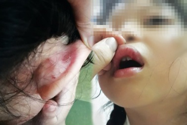 Phụ huynh tố cô giáo đánh học sinh vì làm toán sai: Công an đang điều tra