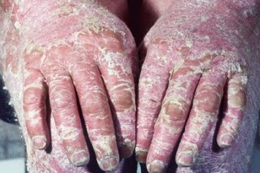 “Quảng cáo chữa khỏi bệnh vẩy nến là trò lừa bịp”