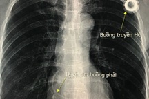 Lấy dị vật kẹt trong tim cho người bệnh ung thư vú