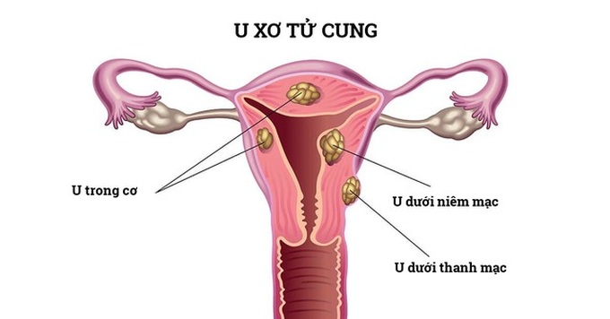 Hình ảnh u xơ tử cung.