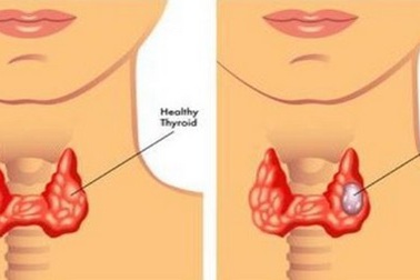 Ung thư vòm họng: Dấu hiệu nhận biết sớm và cách điều trị