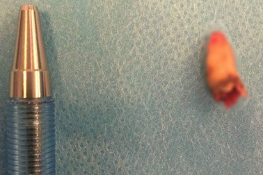 Mất khứu giác 3 năm, người đàn ông bàng hoàng phát hiện răng mọc trong… mũi