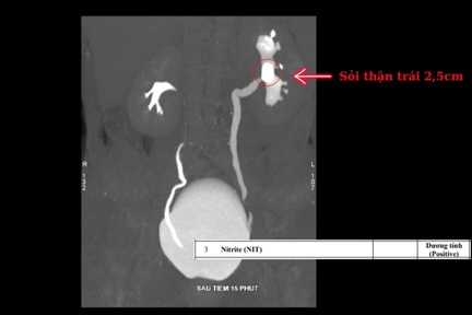 Chữa đau lưng 6 năm mới phát hiện nguyên nhân do sỏi thận