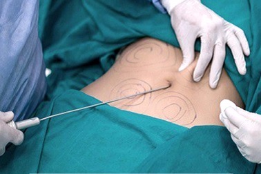 Vụ tai biến thẩm mỹ: Bệnh viện đa khoa Gia Định phải tạm ngưng hút mỡ bụng