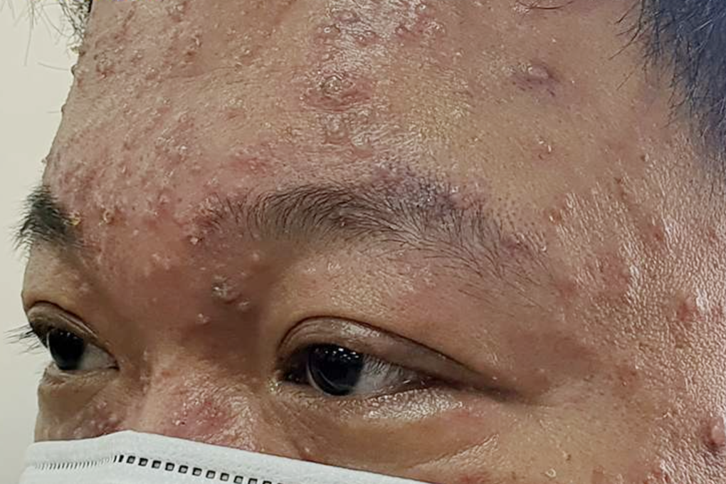Hàng loạt người vào viện vì nắng gắt ở TPHCM: Da nổi sần, ngứa khắp cơ thể - 2 Hàng loạt người vào viện vì nắng gắt ở TPHCM: Da nổi sần, ngứa khắp cơ thể - 2