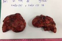 Phẫu thuật "giải thoát" cho cụ bà khỏi những khối u "siêu khổng lồ"