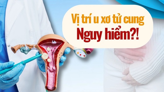 U xơ tử cung nhỏ nhưng vẫn nguy hiểm nếu nằm ở vị trí “nhạy cảm”