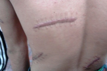 Đang đứng hóng gió, vô cớ bị chém rụng thận trái