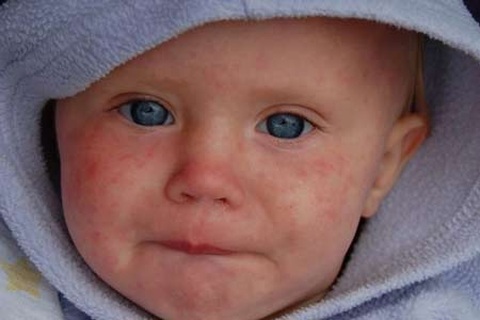 Mỹ: Dịch sởi lớn nhất trong vòng 20 năm!