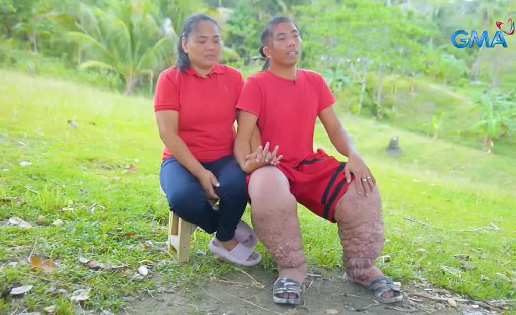 Chuyện tình cảm động của chàng trai Philippines mắc bệnh chân voi - 2