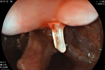 Thứ trong món cá khiến người đàn ông phải cấp cứu